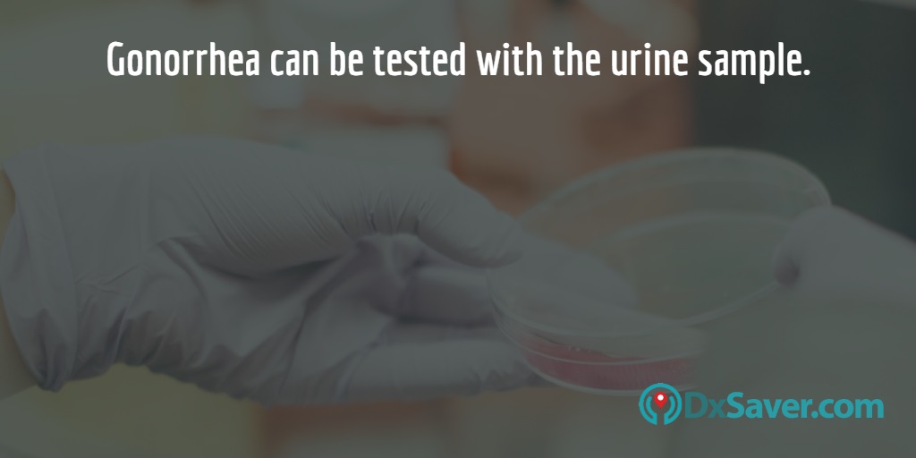 Image with a urine sample where the sample is used to test for Gonorrhea infection.