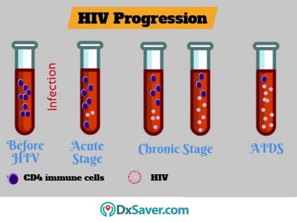 Know more about the HIV progression in different HIV stages.