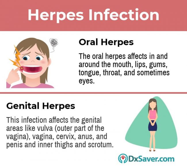 What is herpes? What is Genital herpes and oral herpes and their symptoms