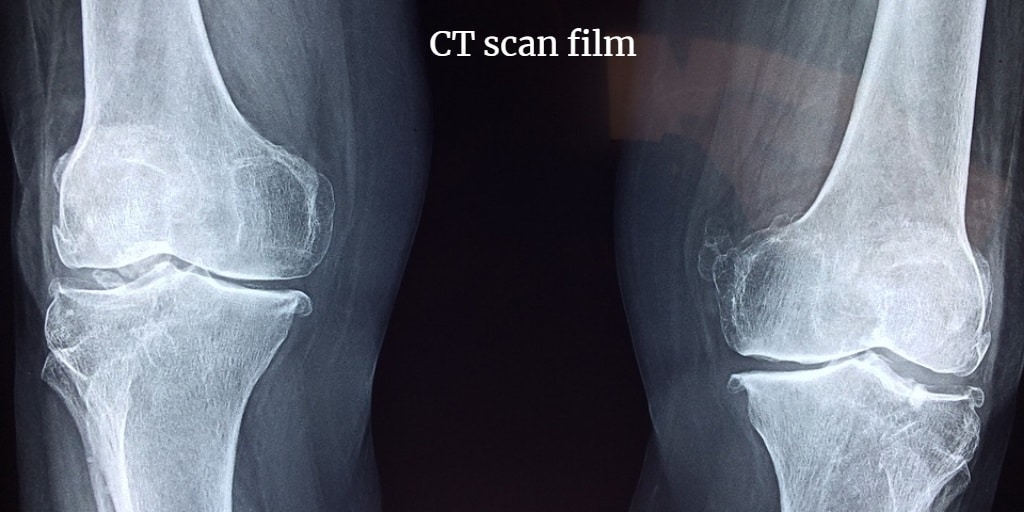 This images clearly shows the film of ct scan knee.