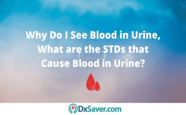 Know more about what causes blood in urine and STDs with blood in urine