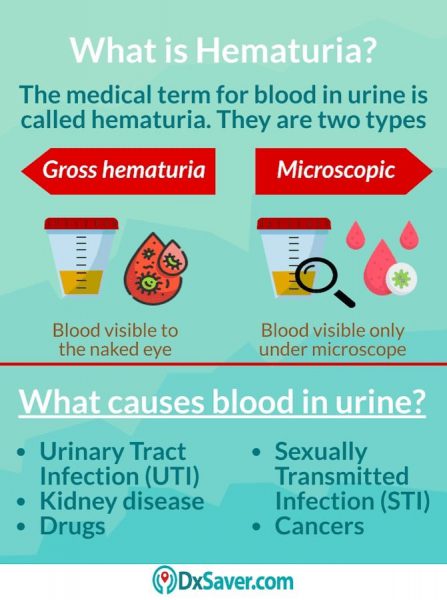 What is hematuria? Also know more about what STD cause blood in urine