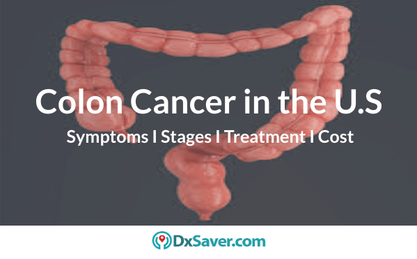 Colon cancer stages-more about test for colon cancer & treatments